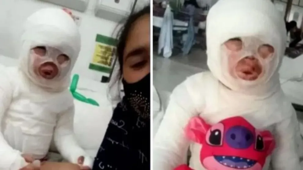 Llevó a su hija a comer y terminó en el hospital con todo el cuerpo quemado